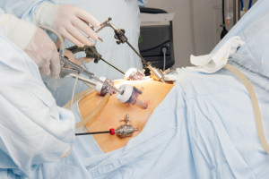gastric bypass procedure taking place