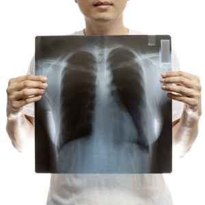 Cancer Misdiagnosis Attorneys in Hollywood Florida are ready to help you